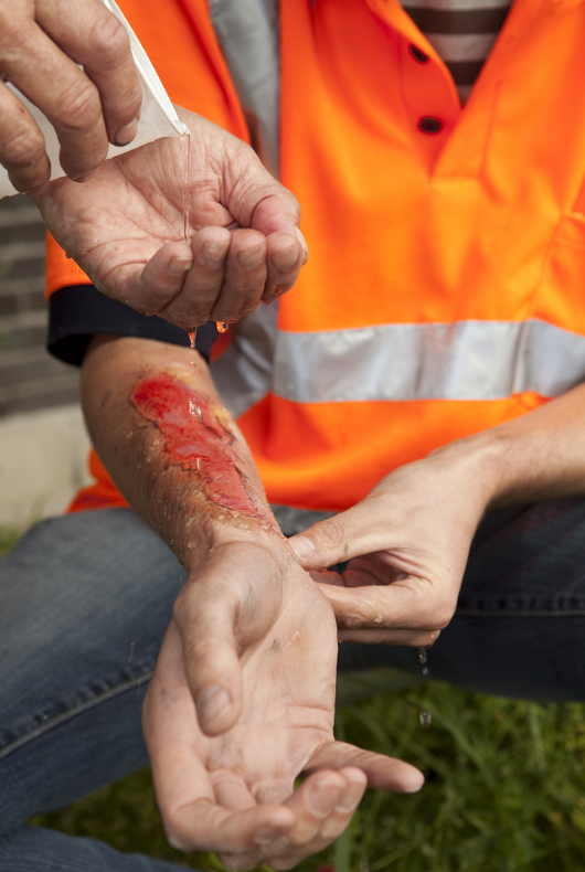 Phoenix Burn Injury Attorney