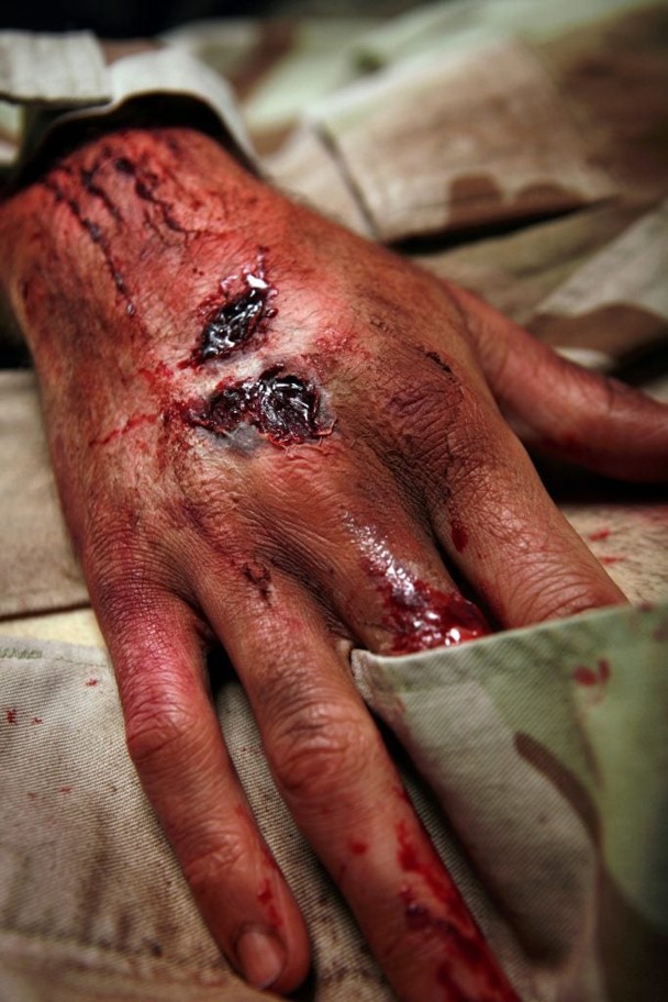 Phoenix Burn Injury Attorney