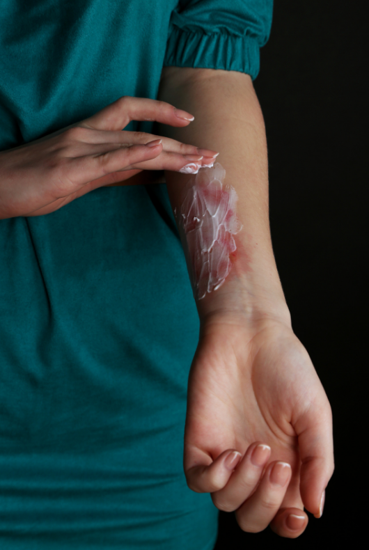 Phoenix Burn Injury Attorney